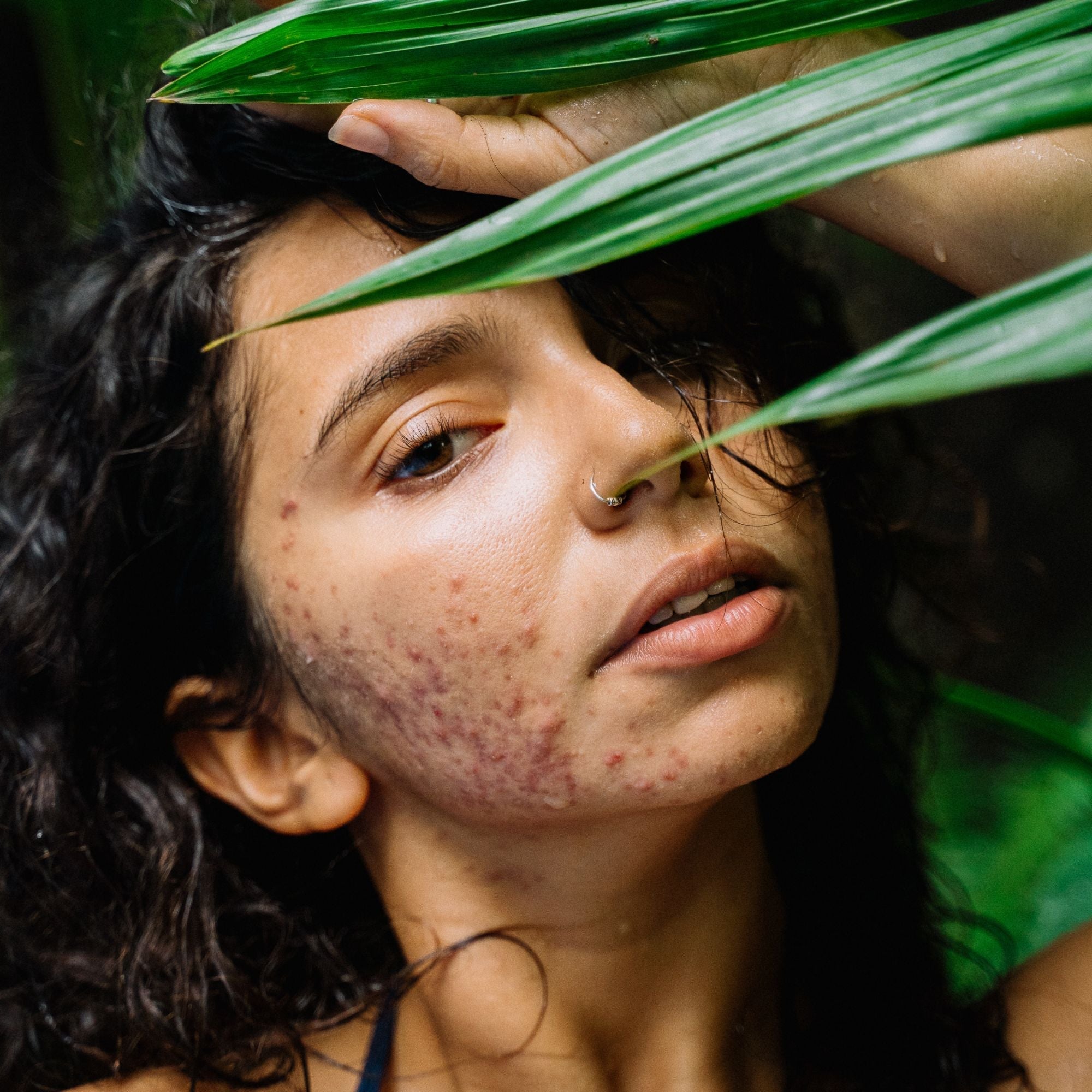 The Ultimate Science-Backed Guide to Acne: Debunking Myths and Unlocking Clear, Healthy Skin